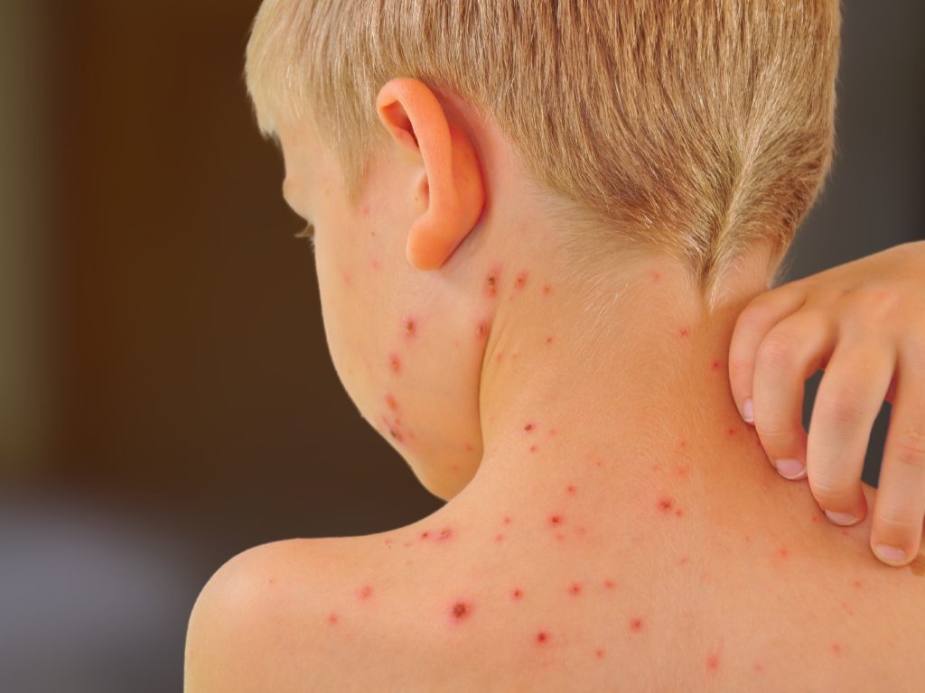Alla barn ska få gratis vattkoppsvaccin